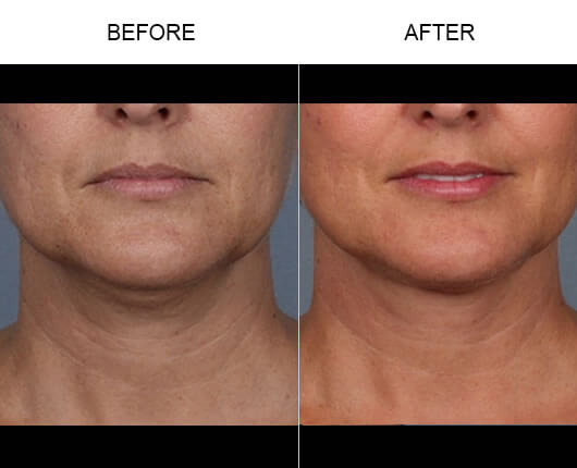 Kybella™ Before And After