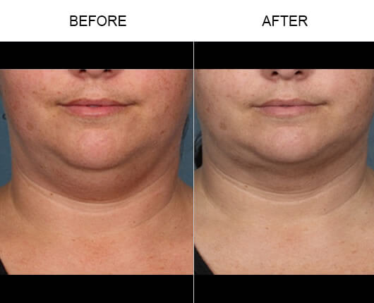 Kybella™ Injections Before And After