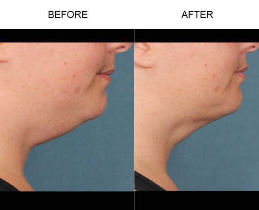 Kybella™ Injections Results