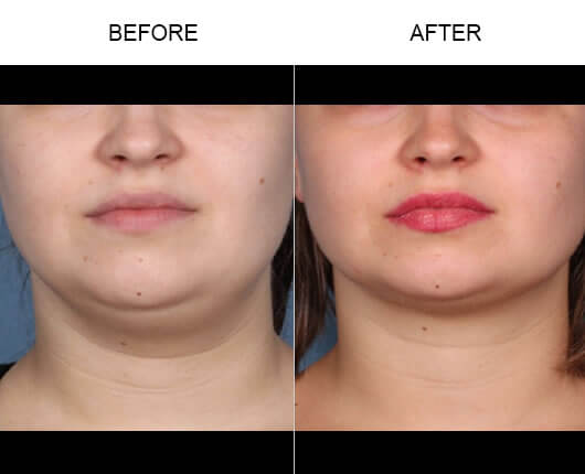 Double Chin Treatment Before And After
