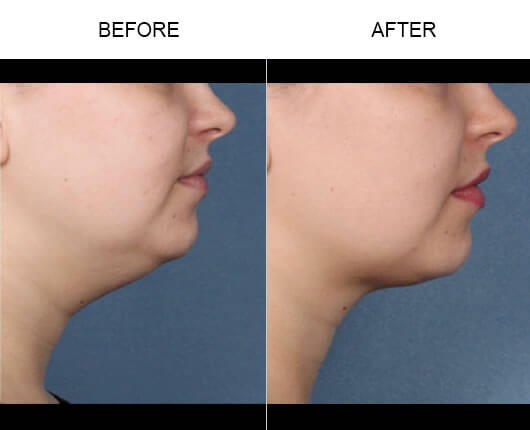 Double Chin Treatment Results