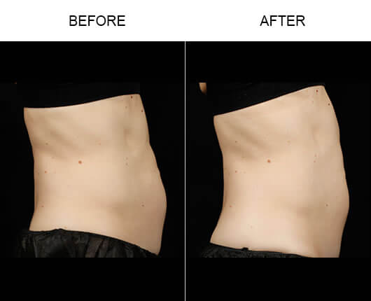 Laser Fat Removal Results