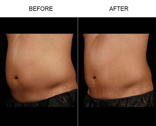 Before And After Laser Fat Removal