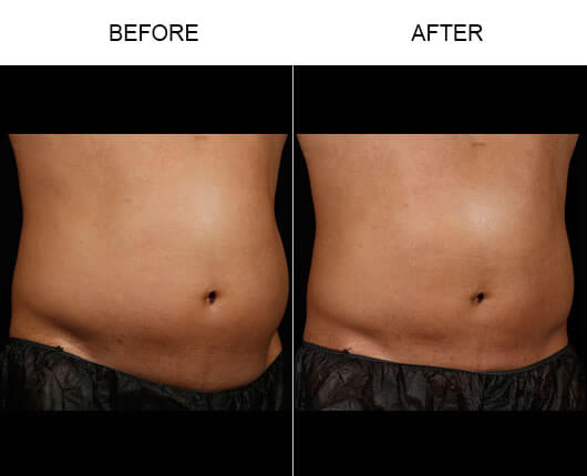 Before & After Laser Fat Removal
