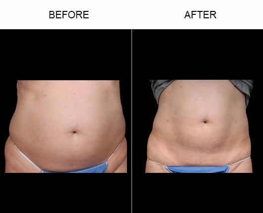 Aqualipo® Before And After