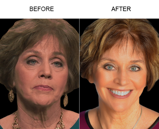 Blepharoplasty Surgery Before And After