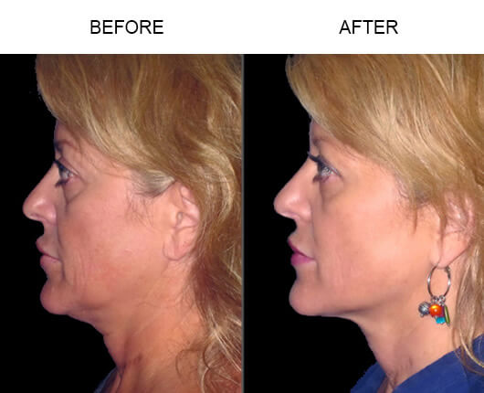 LazerLift® Before And After