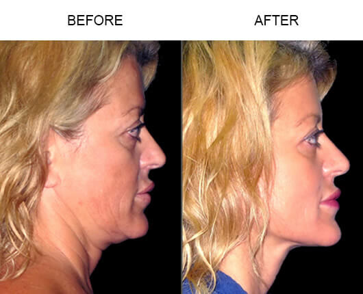 LazerLift® Procedure Before And After