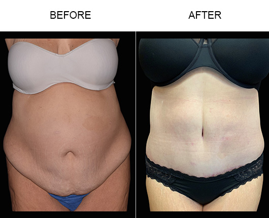 LowCut Tummy Tuck Before & After