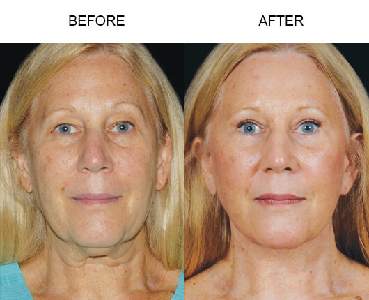 Mini Facelift Surgery Before And After