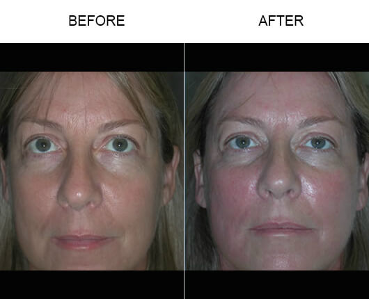 Thermage® Results