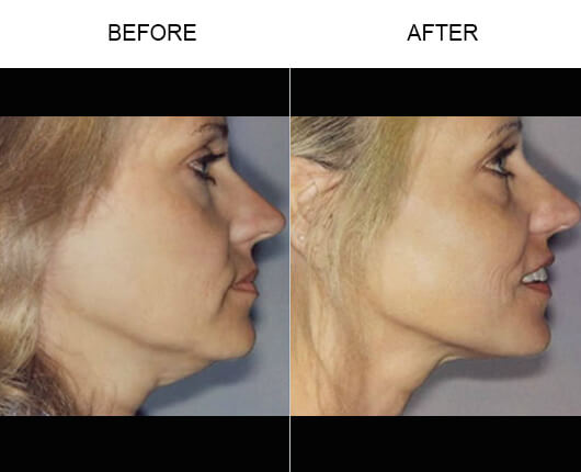 Thermage® Patient Before And After
