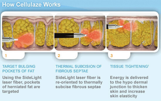 Cellulite Removal With Cellulaze™