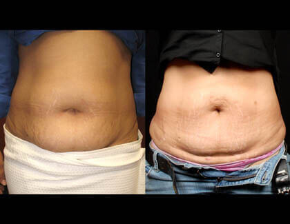 SmatLipo Before And After